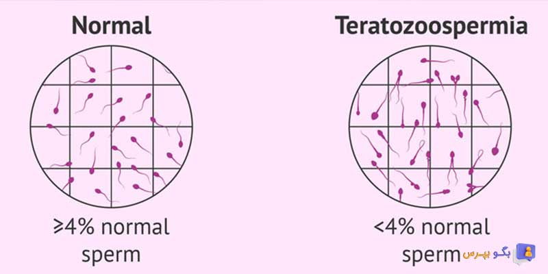 بارداری با موفولوژی پایین اسپرم
