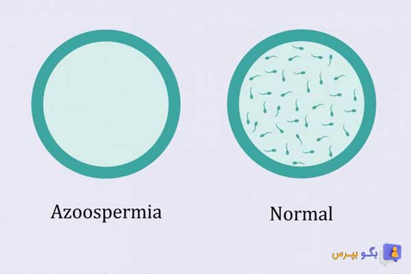 آیا اسپرم صفر درمان می شود